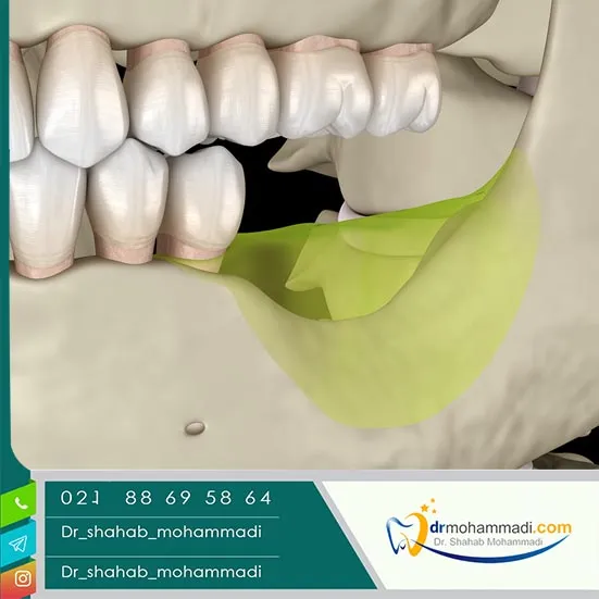 اگر ایمپلنت نکنیم چه میشود؟